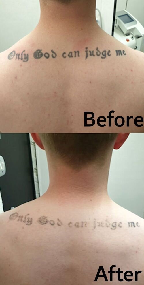 Dublin tattoo removal, laser tattoo removal